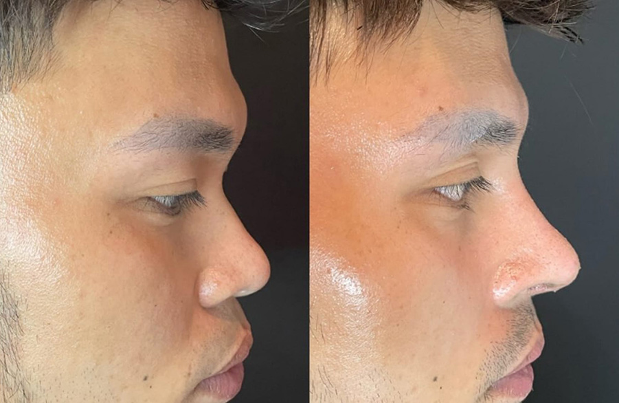 Rhinoplasty Slide