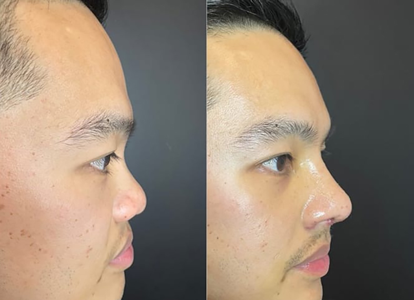 Rhinoplasty Slide